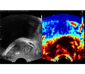 Elastography Munich